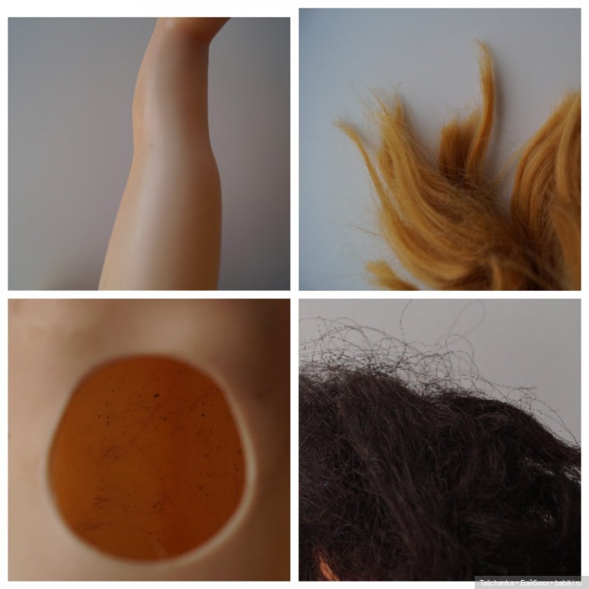 Четвёртая мартовская выписка. Машенька снова бегает и поёт! А перелом ноги исправлен за 10 минут