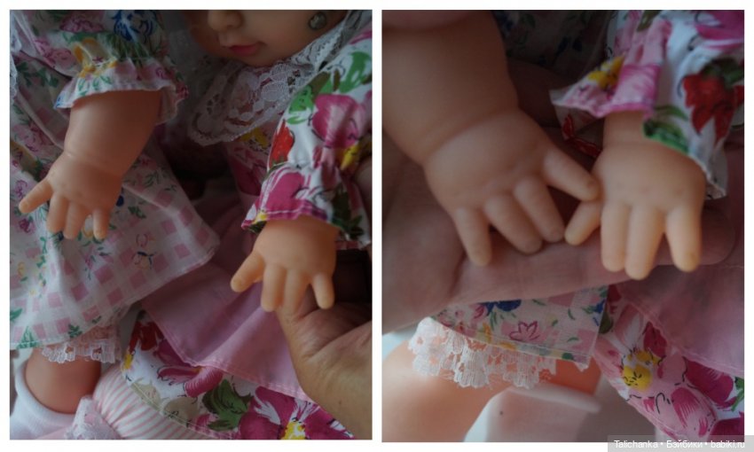 Третья выписка августа. Нейрохирург вылечил малюток. Вправляем тазобедренный вывих. Базироним гематомы и ссадины