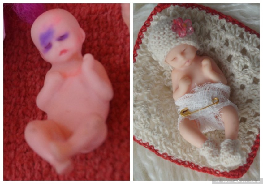 Третья выписка августа. Нейрохирург вылечил малюток. Вправляем тазобедренный вывих. Базироним гематомы и ссадины