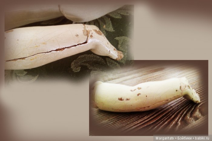 Спасение безноженьки. Часть 2. Хирургия и трансплантация