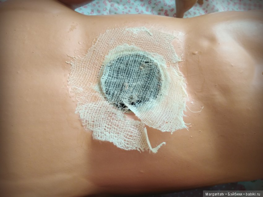 Лечение куколки фабрики Зонненберг