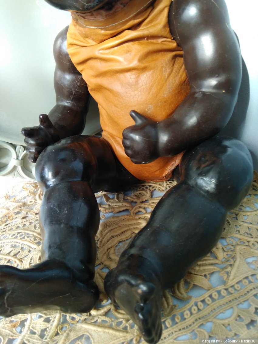 Лечение ножки темнокожего малыша