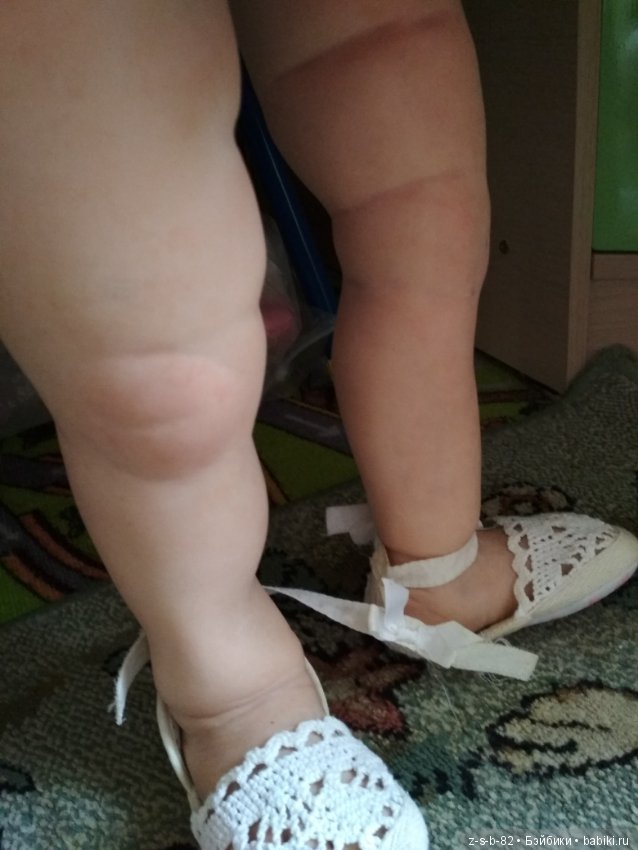 Деформация конечностей у тодлеров. Помогите исправить