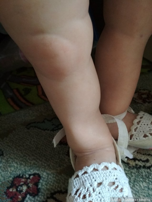 Деформация конечностей у тодлеров. Помогите исправить (фото 3)