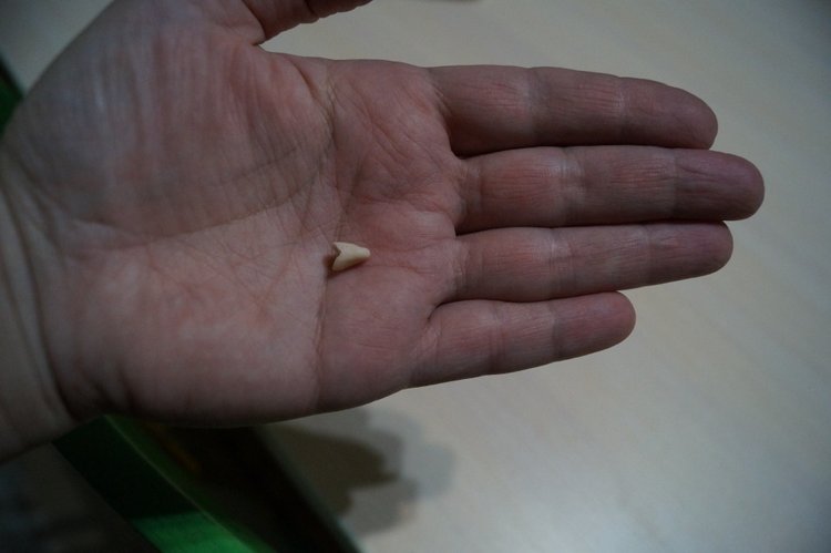 Третья выписка ноября. Лечим перелом колена, ставим донорские ручки. Анжелочка выздоровела + история-воспоминание о детском