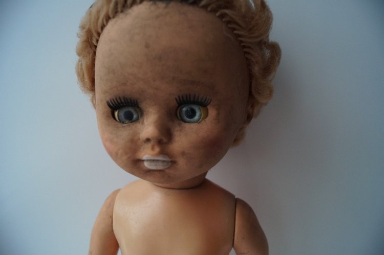 Третья выписка ноября. Лечим перелом колена, ставим донорские ручки. Анжелочка выздоровела + история-воспоминание о детском