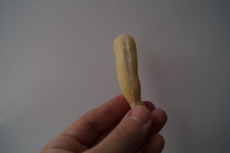 Третья выписка ноября. Лечим перелом колена, ставим донорские ручки. Анжелочка выздоровела + история-воспоминание о детском