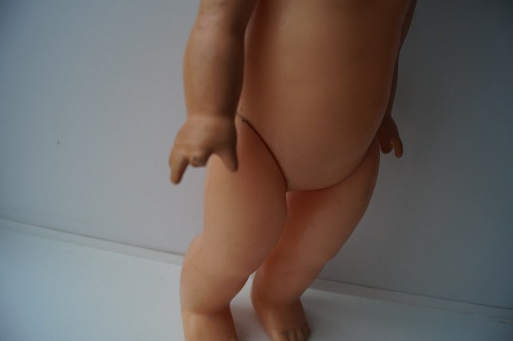 Третья выписка ноября. Лечим перелом колена, ставим донорские ручки. Анжелочка выздоровела + история-воспоминание о детском