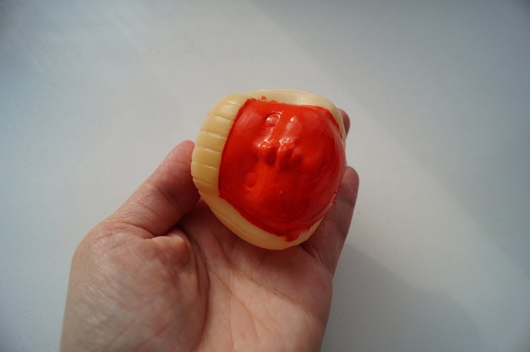 Третья мартовская выписка. Вылечено два перелома