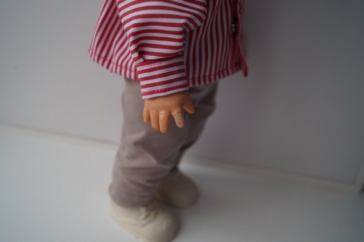 Третья выписка ноября. Лечим перелом колена, ставим донорские ручки. Анжелочка выздоровела + история-воспоминание о детском