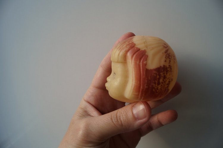 Третья мартовская выписка. Вылечено два перелома